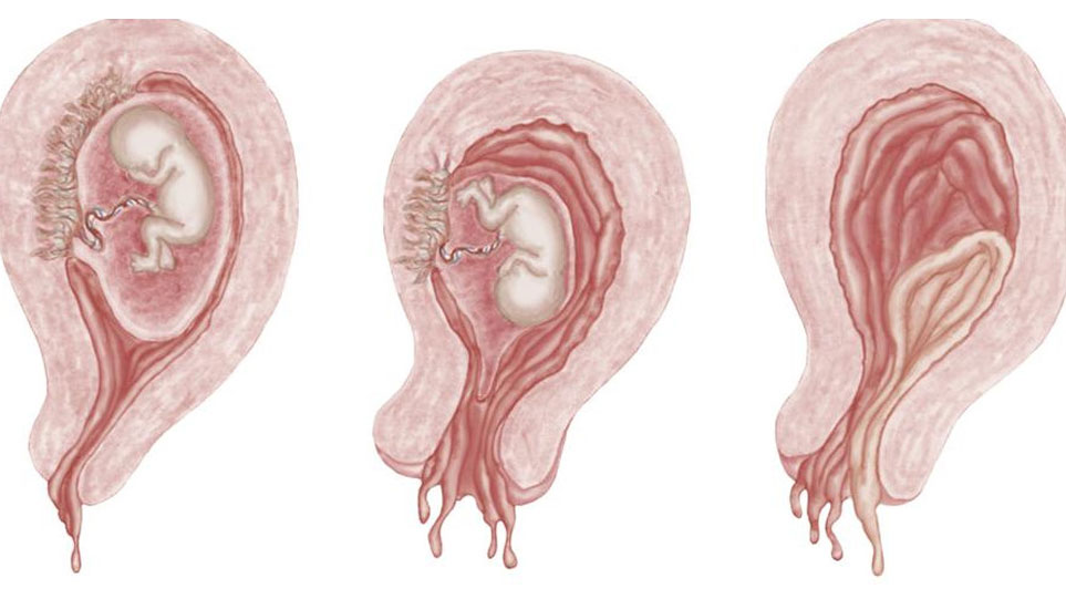 تهدید به سقط جنین چیست و چه علائمی دارد؟