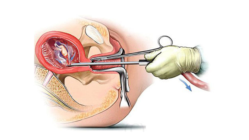 خطرات سقط با جراحی