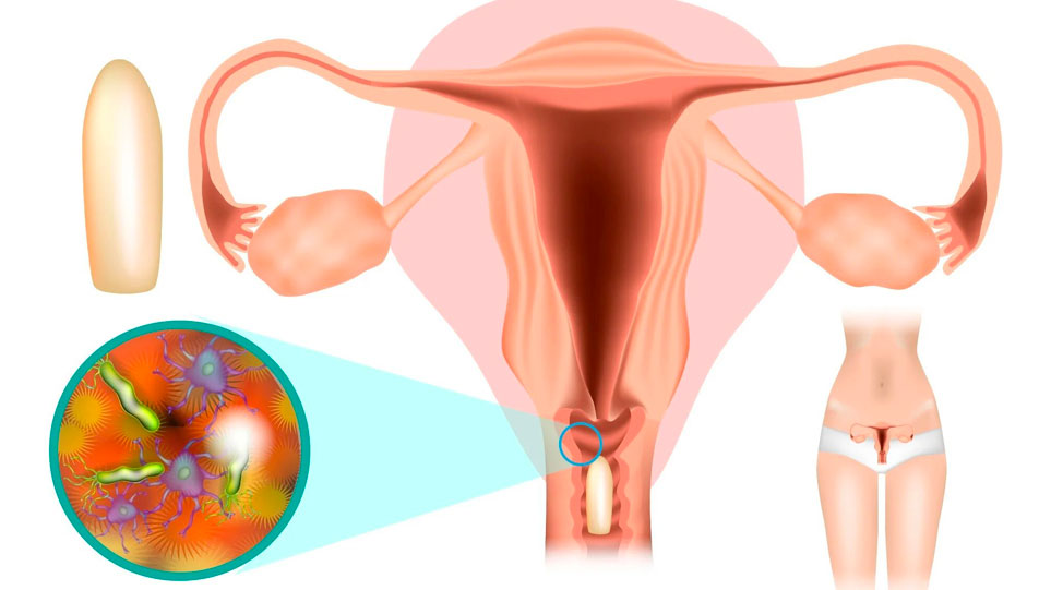 تشخیص علت ترشحات واژن