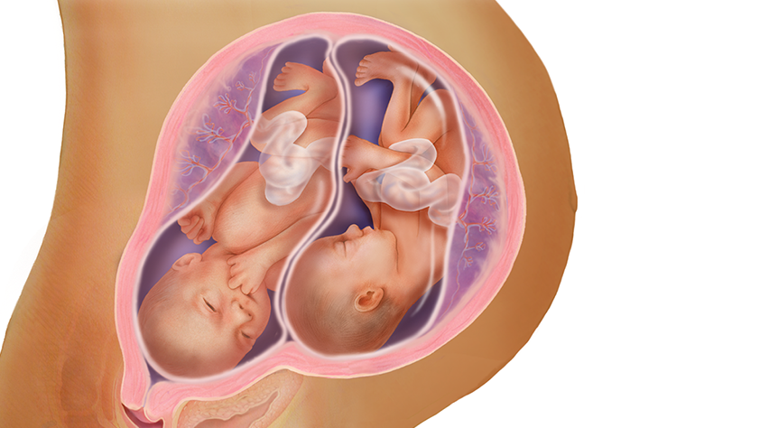 رشد جنین دوقلو در ۲۸ هفتگی