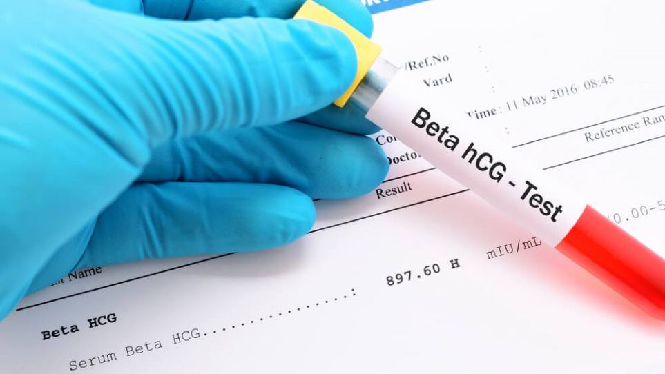 در مورد آزمایش خون hCG بدانید
