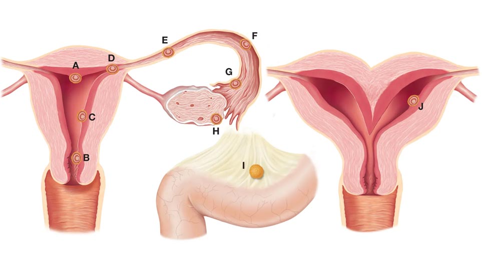 انواع حاملگی خارج از رحم