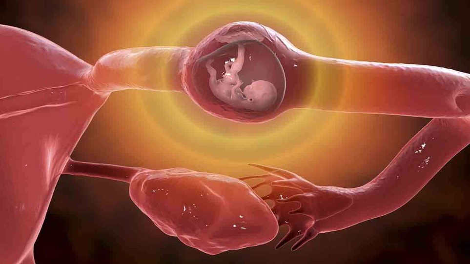 بارداری خارج رحمی لولهای