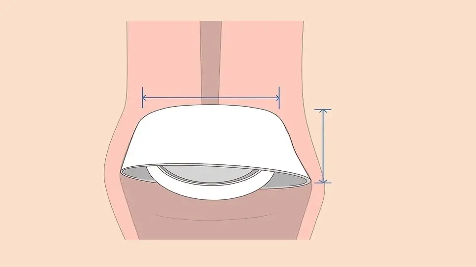 سایز مناسب کلاهک دهانه رحم
