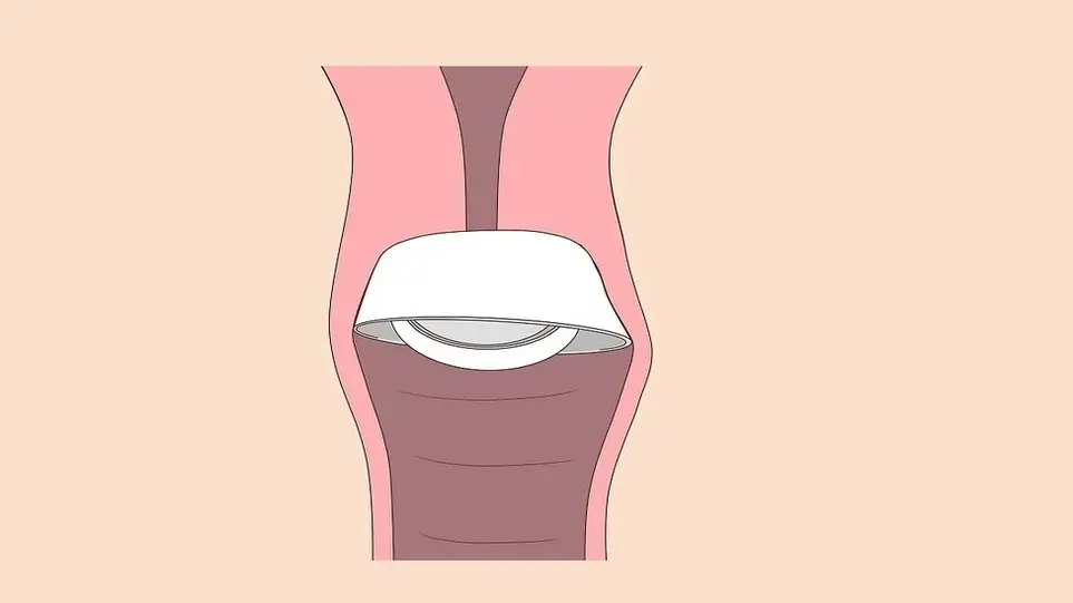 کلاهک دهانه رحم چیست