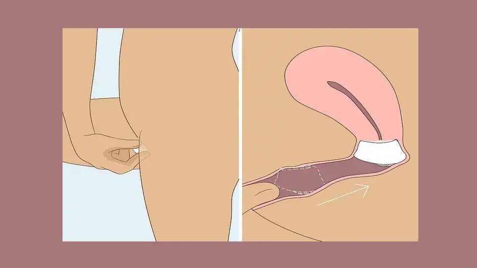 نحوه استفاده از کلاهک دهانه رحم برای جلوگیری از بارداری