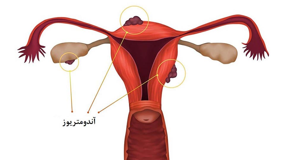 عارضۀ آندومتریوز و ناباروری