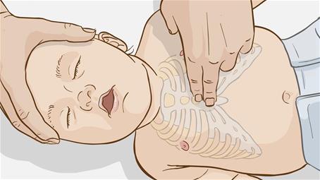 احیای قلبی تنفسی یا CPR کودک زیر یک سال
