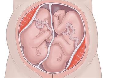 وضعیت قرارگیری دوقلوها در رحم: با چه روشی زایمان میشوید؟